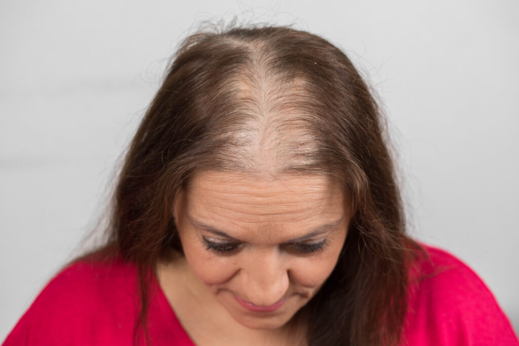 Oberkopfverdichtung mit dem HairContrast T-Parting