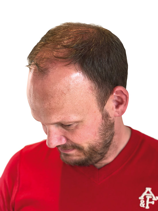 AirSkin Denmark Toupet Herren